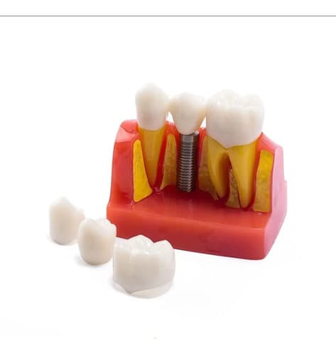 Macromodelo Implante Dental — imagen 1 de 6